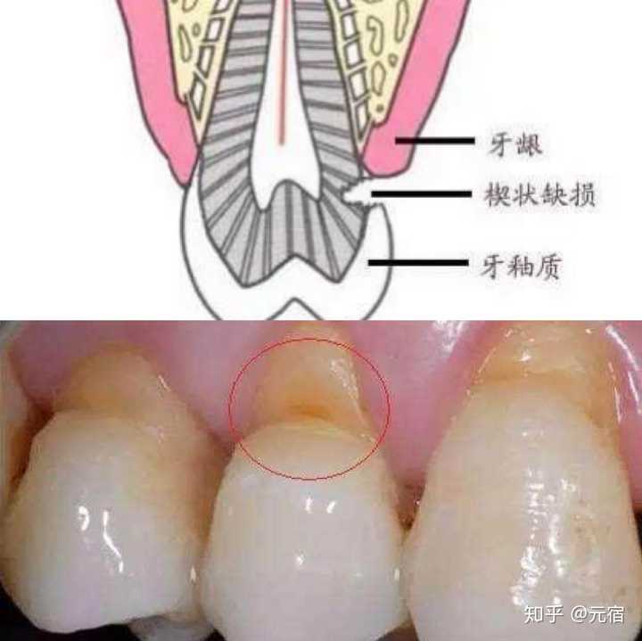 力度过大,再加上过硬的刷毛会加速楔状缺损产生,缺损主要在牙齿颈部