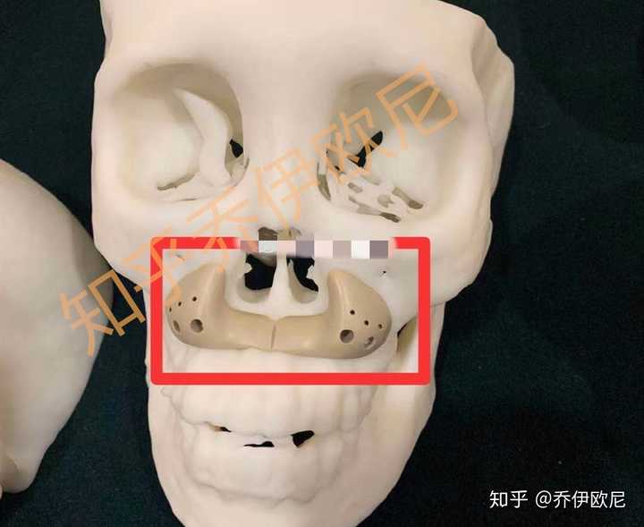 用什么填充鼻基底最好