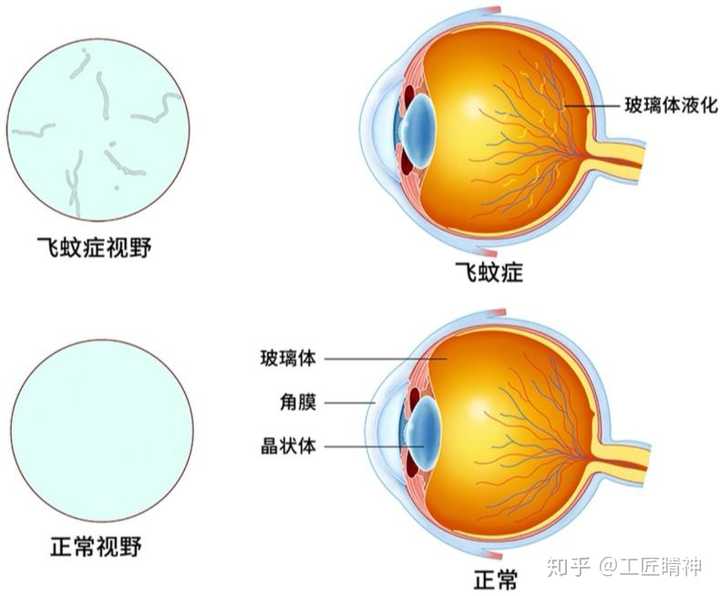 高度近视转眼产生飞蚊症能自愈吗?