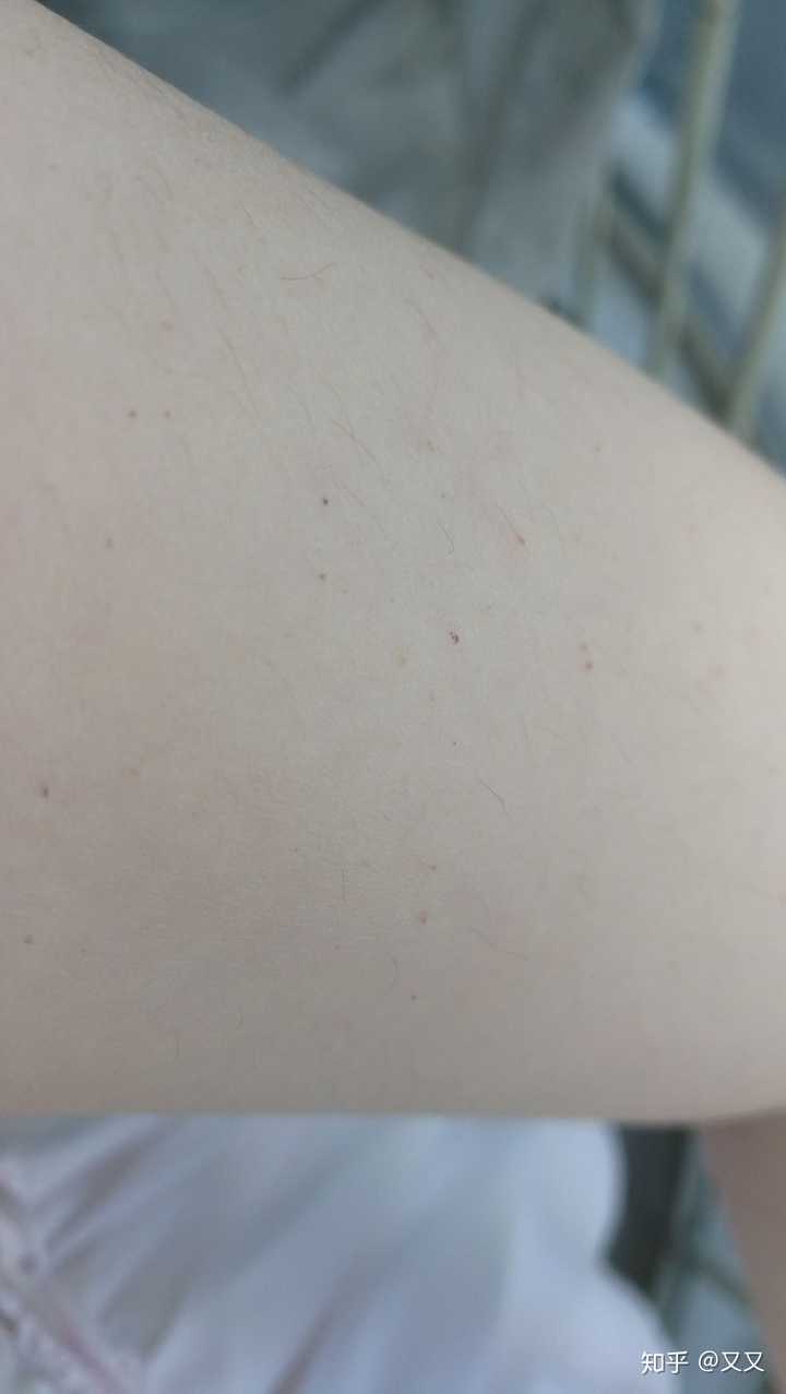 手臂上长了很多小红点是怎么回事?