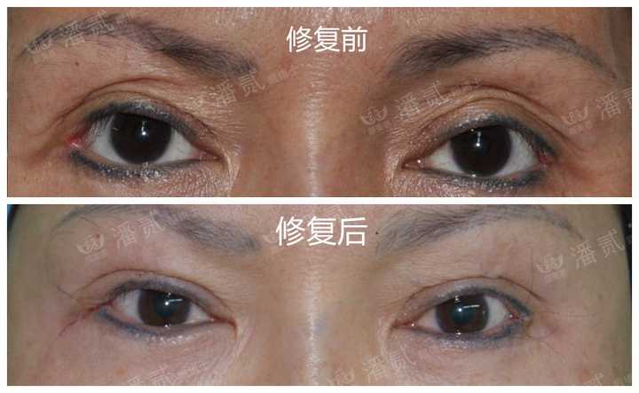 开外眼角有什么不好吗?