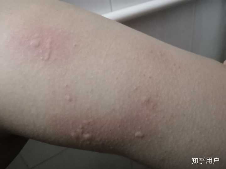 你见过哪些奇怪的过敏源?