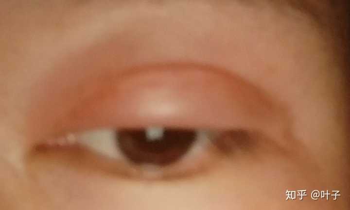眼睛被蚊子叮了,如何快速消肿?
