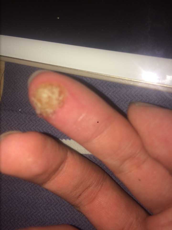 手上长鸡眼?
