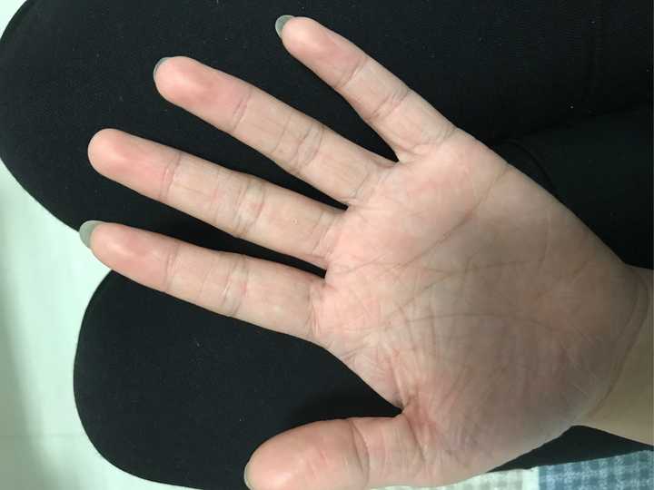 我也是这样 天生的 手干燥粗糙 尤其冬天 比老奶奶的手摸起来还粗 又