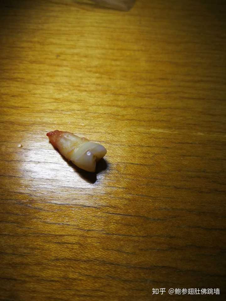 戴过牙套(矫正牙齿)的人脸型变了吗?
