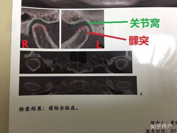 颞颌关节张口弹响,可复性关节盘移位,一定要做手术吗?