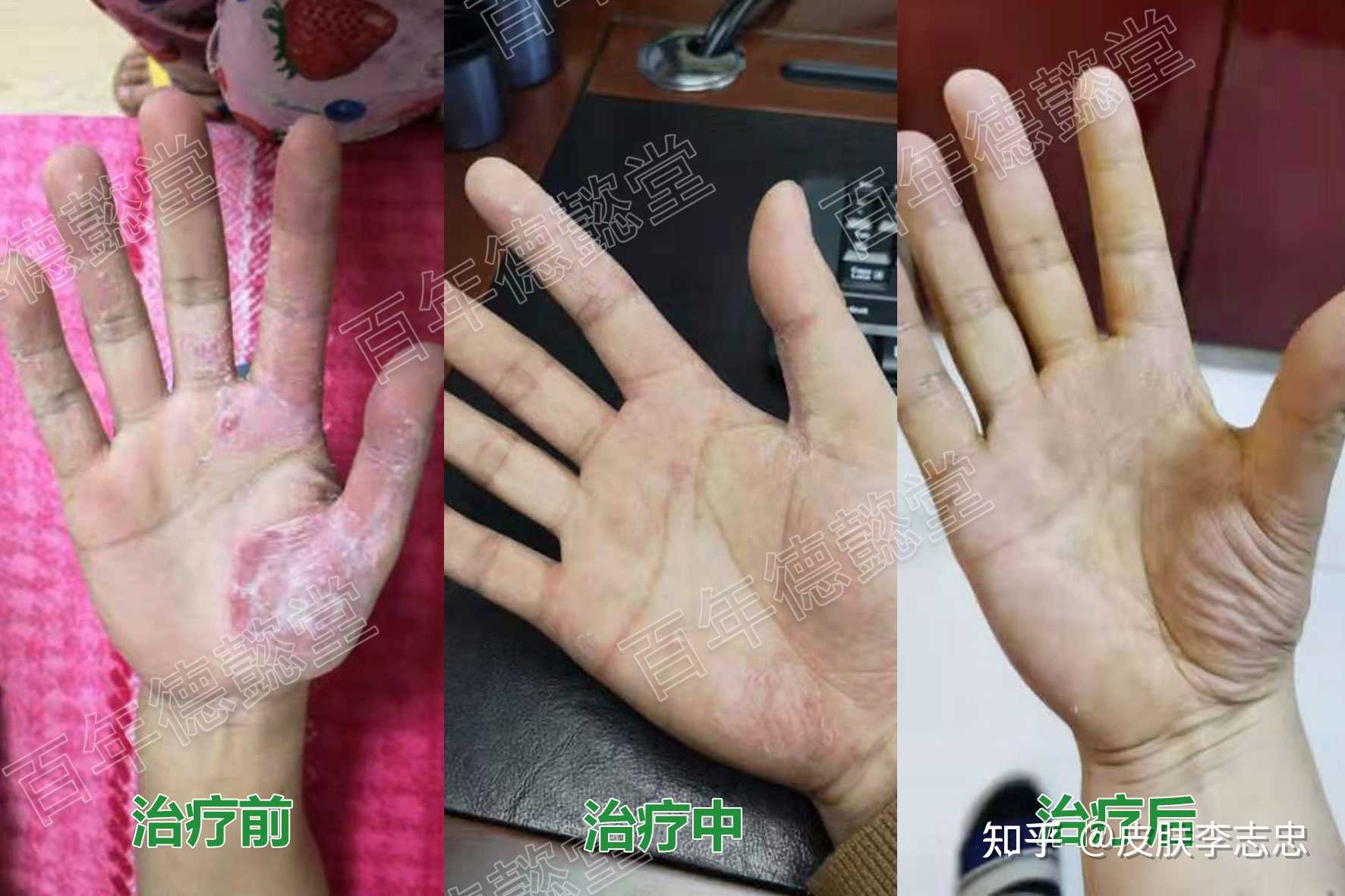 皮肤李志忠 的想法: 掌跖脓疱病是一种损害比较严重的