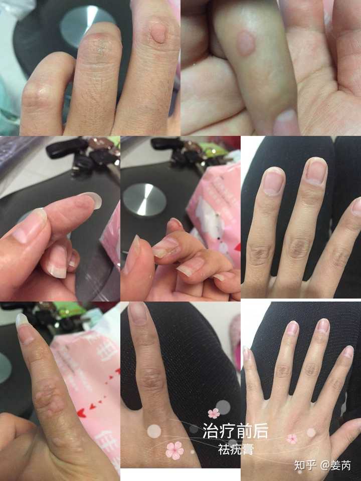 如何治疗疣?长得很多,脖子上都快满了,都是细小的,求高人?