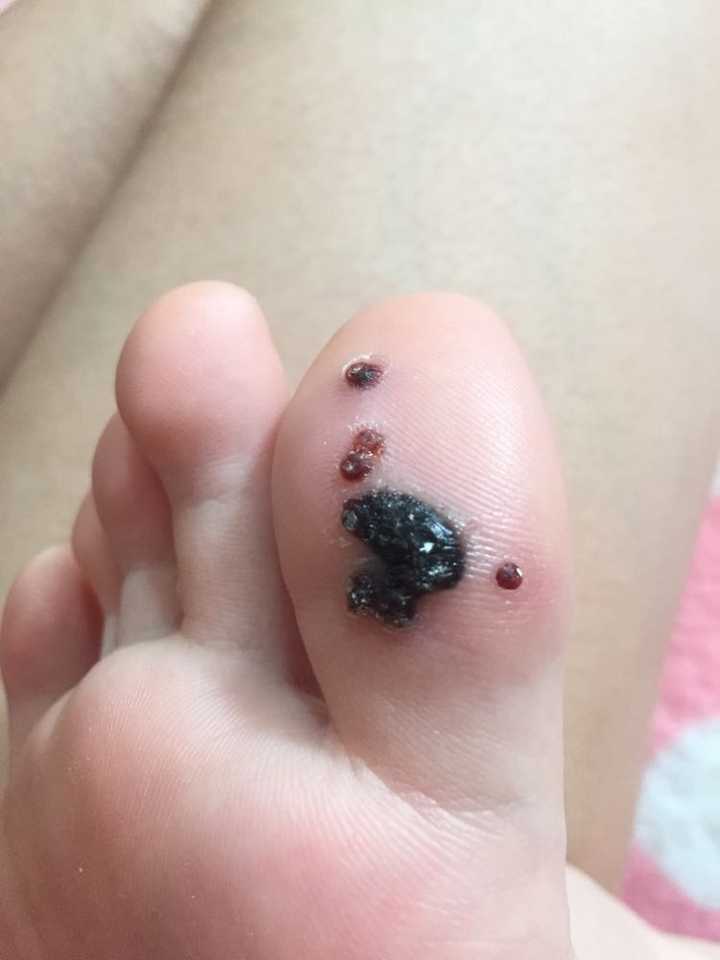 脚底长跖疣怎么办?