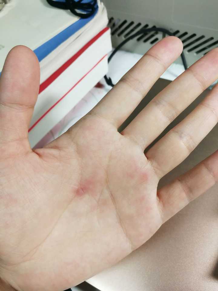 使劲拧的女生最后左手手心破皮了 不信邪且执着的女生最后左手手心起