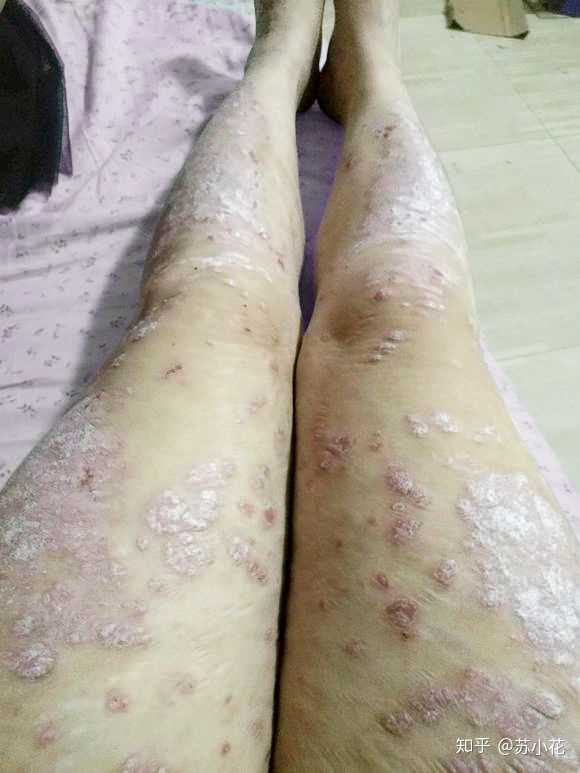 我这是银屑病吗?