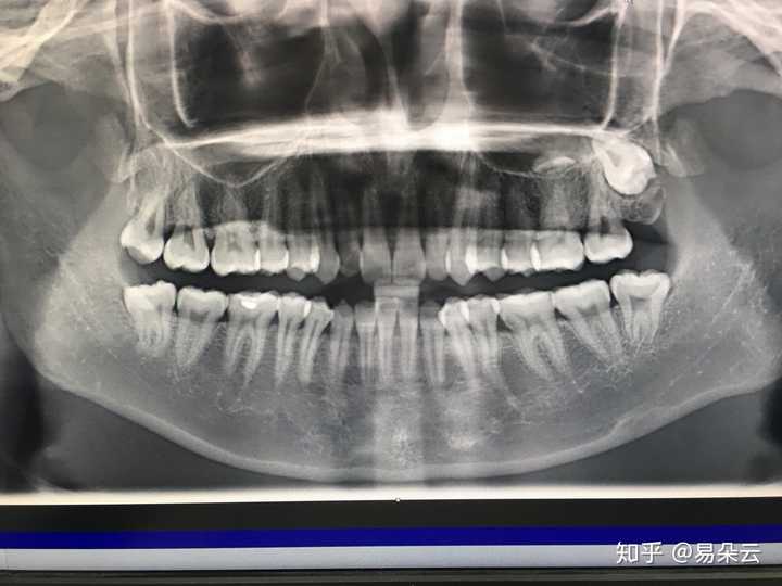 有没有类似生长的智齿?上颌骨有颗智齿长得太有个性了?