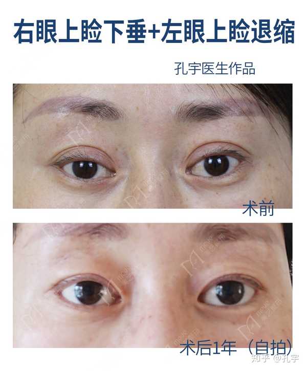 孔宇 的想法: 西藏女士,甲亢病史10余年,做过双眼眶减… - 知乎