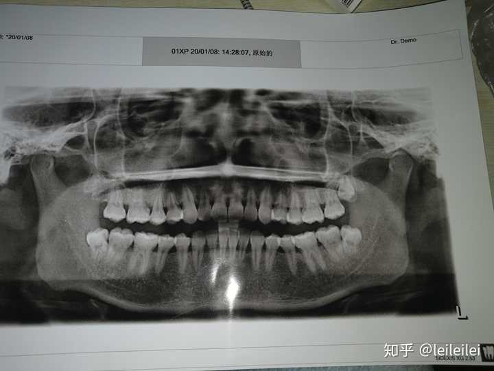 附上我的牙片