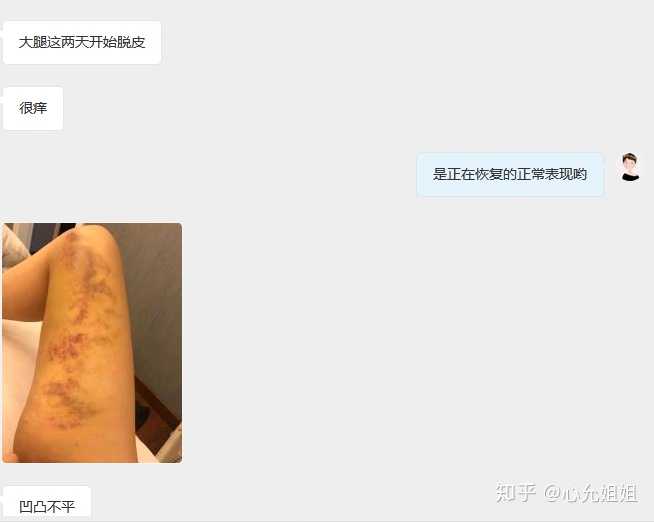 吸脂有哪些危害和后遗症?