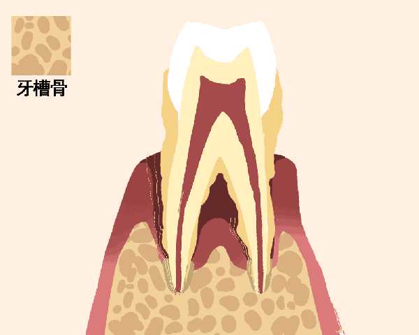 牙齿松动是拔掉还是固定