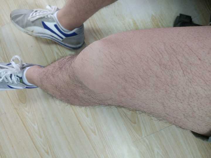 男生腿毛浓密怎么办?