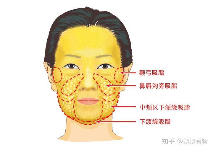 面部吸脂会留疤吗