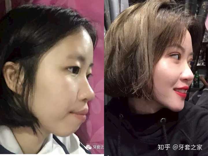 戴牙套可以改善牙齿外凸的程度是多大?(有图)