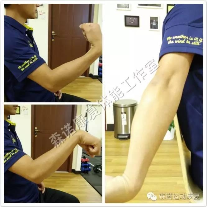1,腕伸肌紧张试验: 患者取坐位或站立位,医者位于其前方,嘱患者前臂