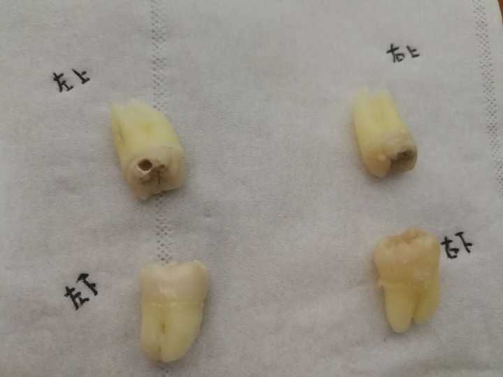 拔智齿有多痛?