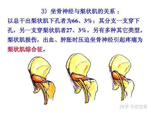 以上:区别于排除梨状肌综合征