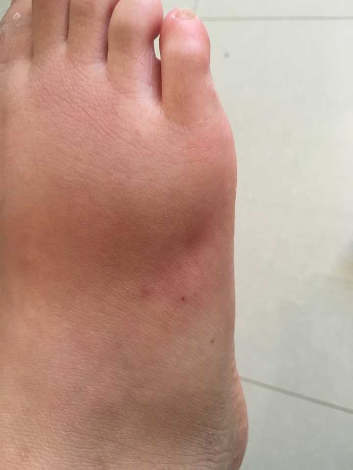 这是我被蜘蛛咬过的脚,已经快好了,但是肿得一恩还是一个坑.