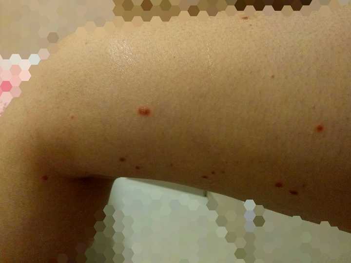 点滴型银屑病怎么办?