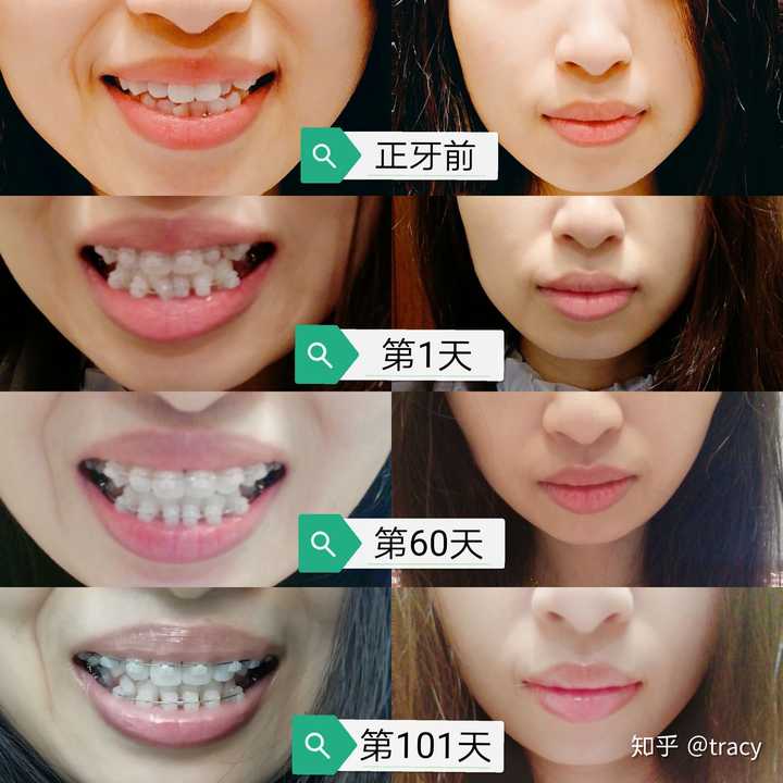 中线差一点对齐,牙齿整齐不少,唇形也有变化.