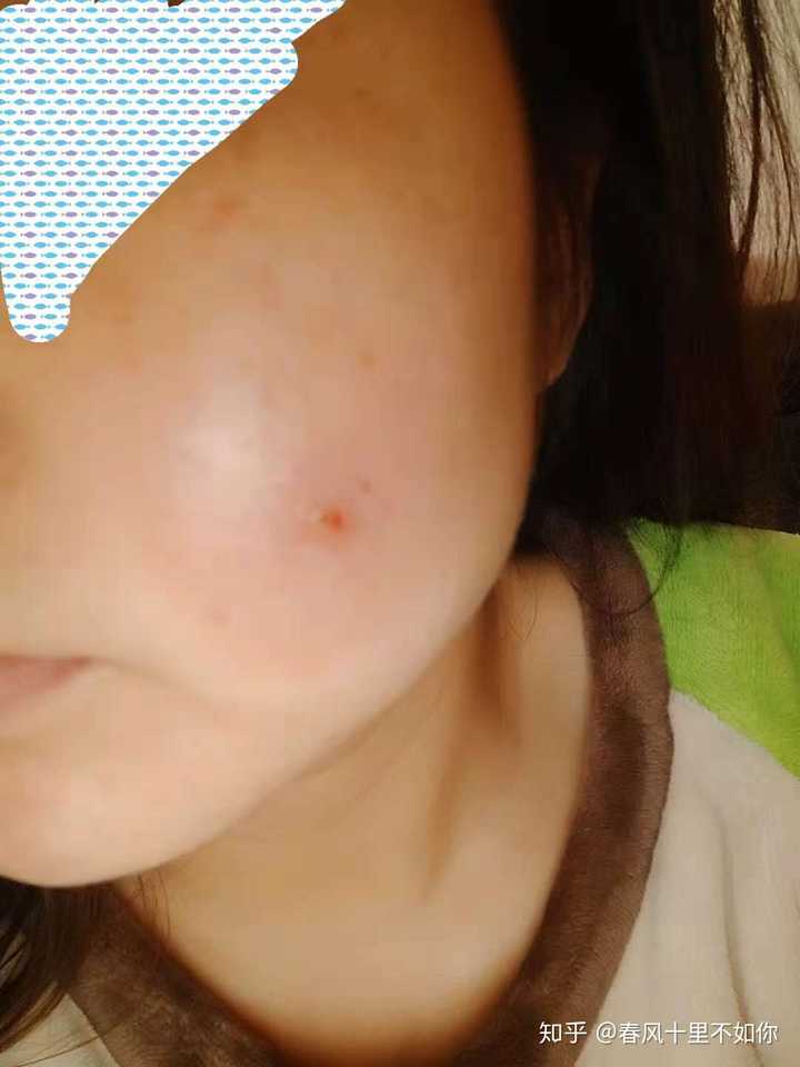 屁股上长个火疖子是什么感受 ?