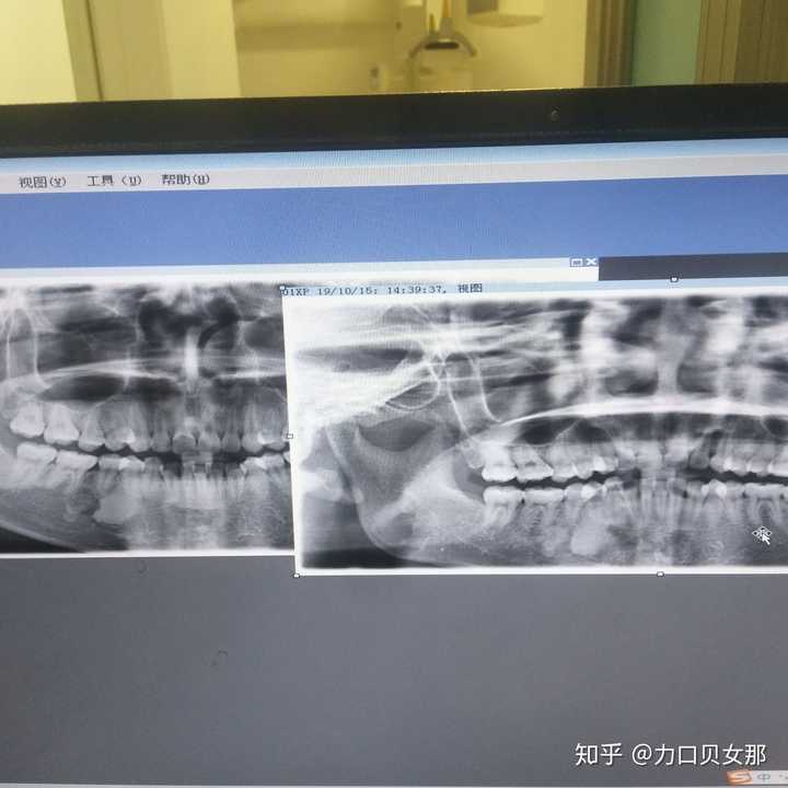 这是我做完牙骨质瘤手术第二年复查的牙片