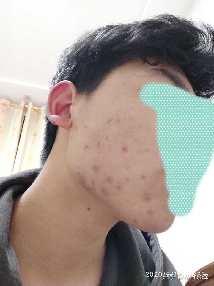 大家对脸上长痘痘的男生怎么看?
