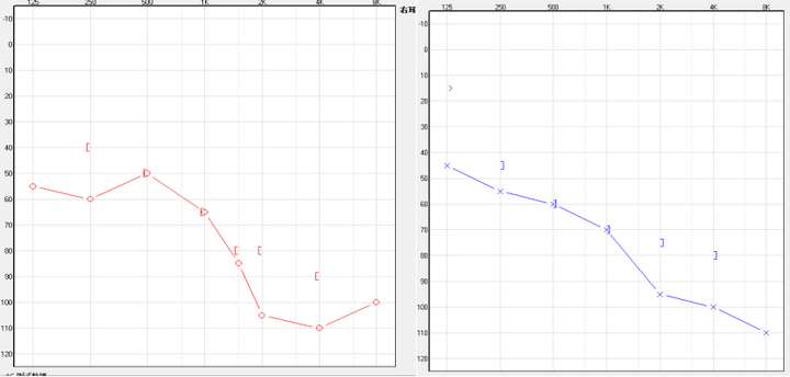 高频陡降型听力损失,一般为低频正常或者轻度听力下降,中高频听力快速