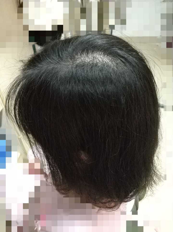 有人用过米诺地尔这种生发药物吗?有用吗?