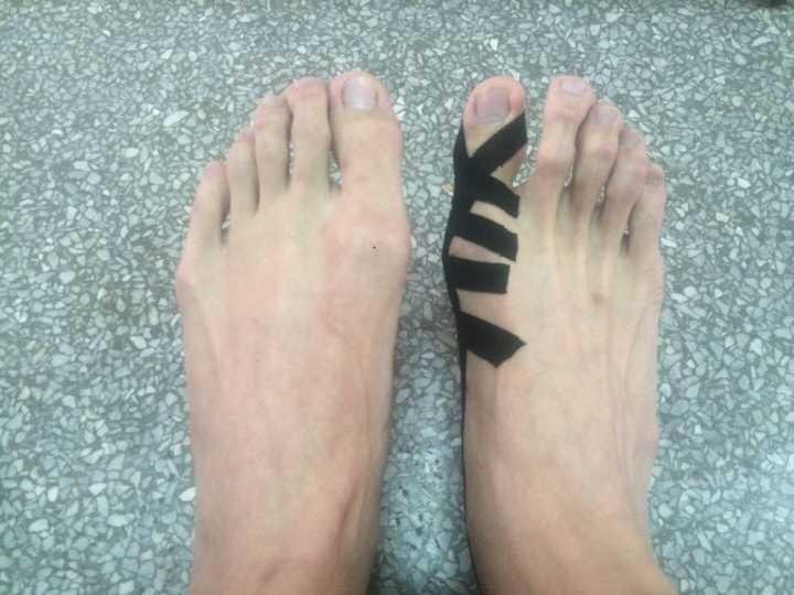 女生脚趾拇外翻是什么样体验?