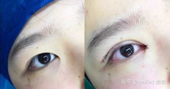 (同理,做双眼皮时候的眼型选择,也是要根据你五官的风格,和三庭五眼