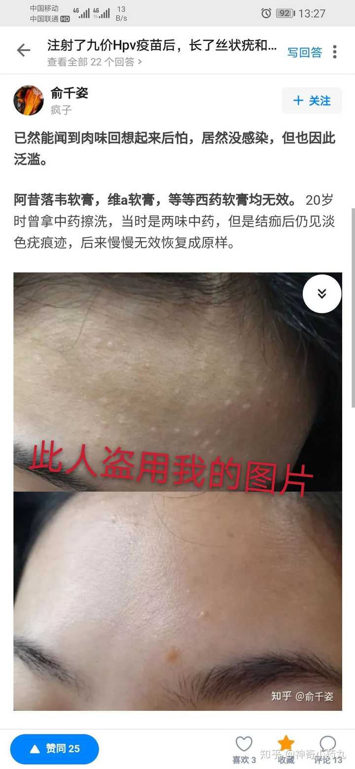 注射了九价hpv疫苗后,长了丝状疣和扁平疣,怎么办?