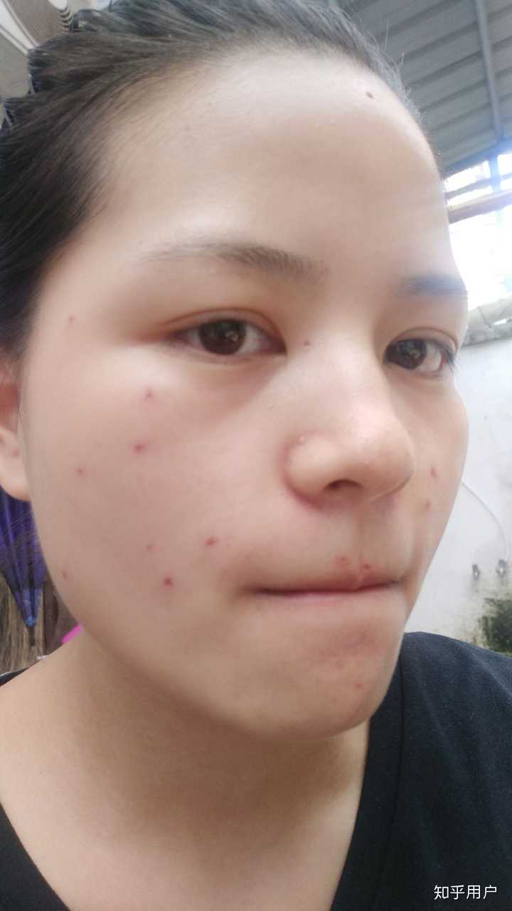 激光点痣祛痣祛斑是什么体验?