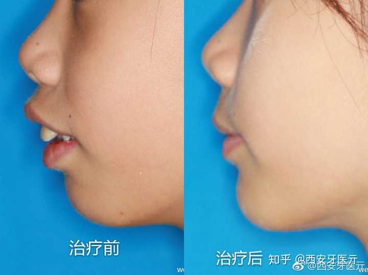 牙齿矫正可以改善睡觉张嘴么?