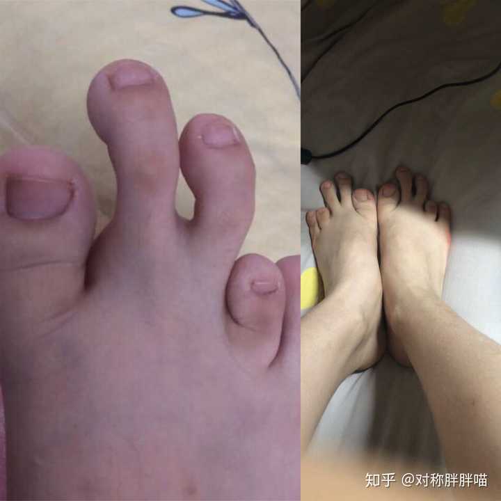 女生脚丑是种什么样的体验?