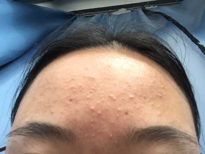 怎么去闭口?