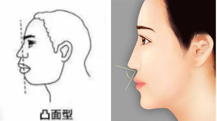 龅牙凸嘴怎么改善侧脸?