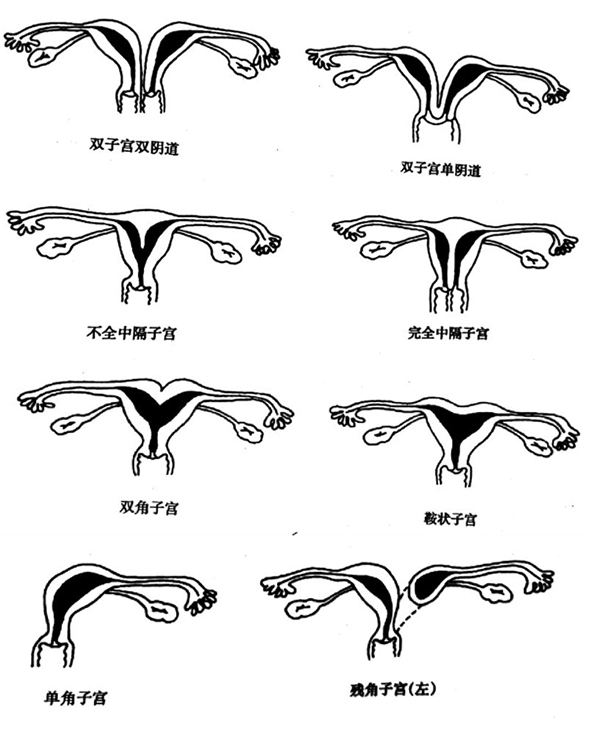 (2)生殖器异常:子宫畸形(如子宫发育不良双子宫,双角子宫,单角子宫