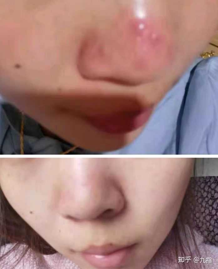 酒糟鼻有什么好的治疗方法?
