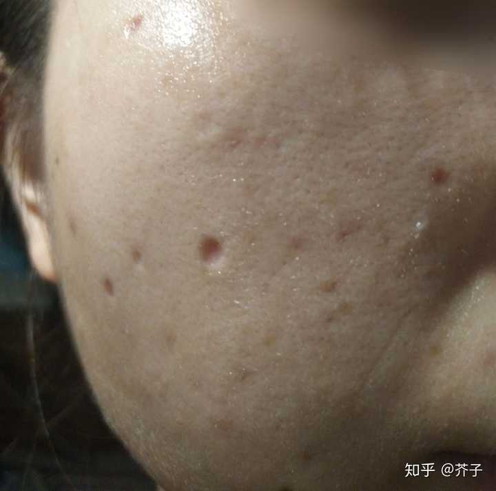 激光点痣祛痣祛斑是什么体验?