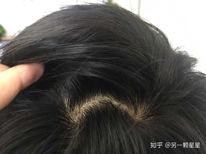 怎么才能让发旋头发变多起来啊?