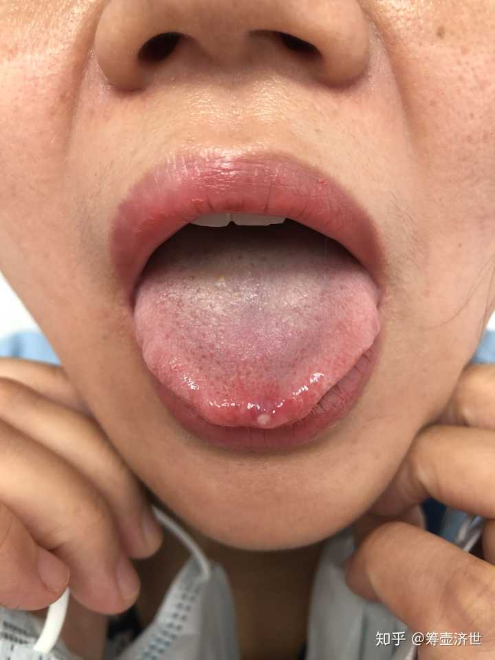 舌头疼痛是怎么回事