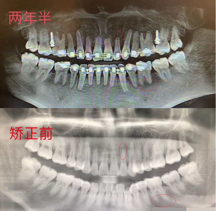 正确的正畸方案会避免出现过度的牙根吸收,所以只要选对医生这方面