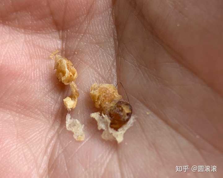 耳屎能大到什么程度?